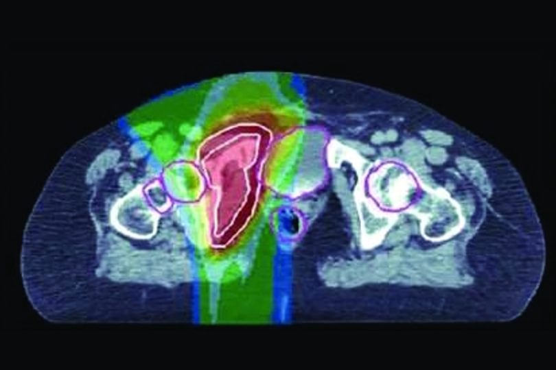 Braintumour